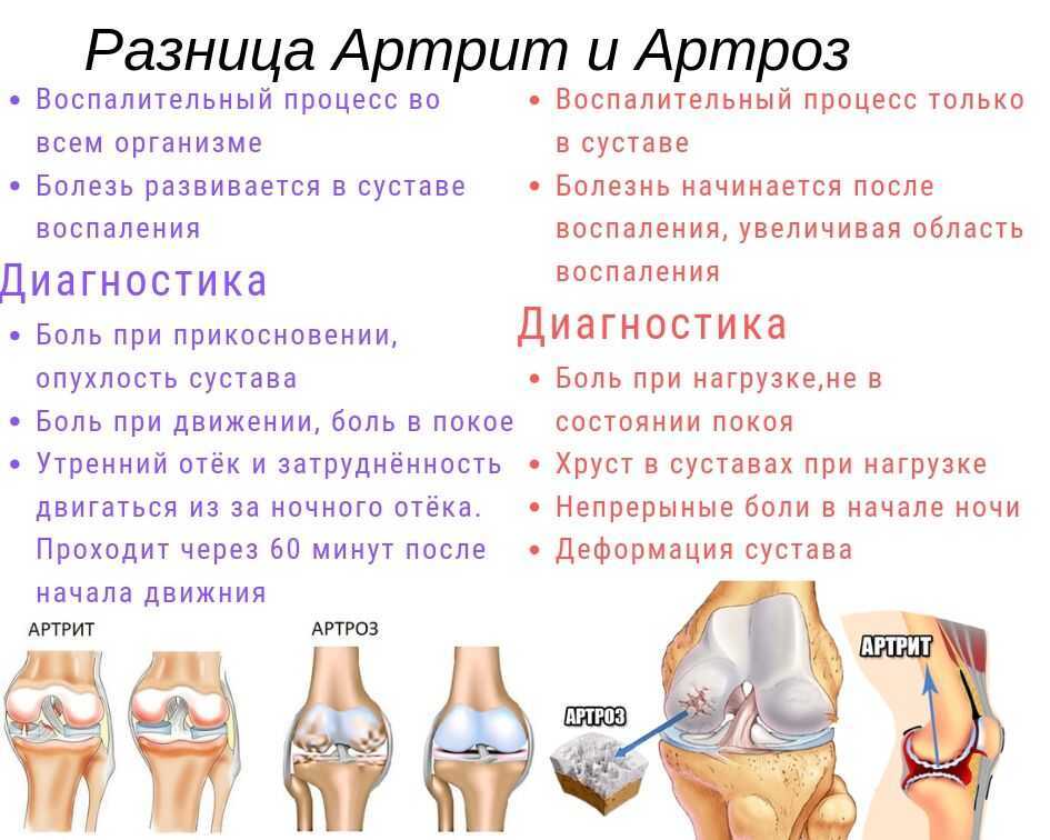 Артроз суставов: лечение, симптомы. степени артроза.