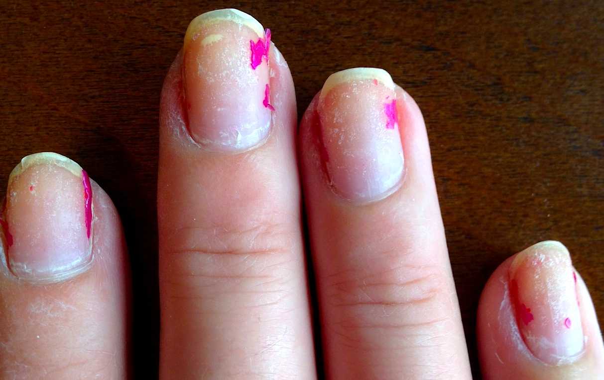 Гель не держится на ногтях причины. Аллергия на праймер для ногтей. Аллергия на гель лак фото. Почему не держится гель лак на ногтях снимается пластами.