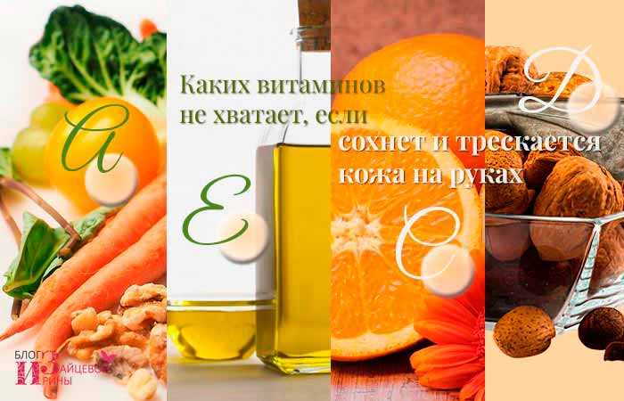 Лечение псориаза на руках