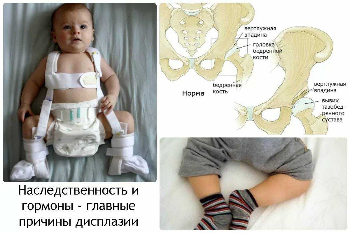 Узи тазобедренных суставов новорожденных грудничков: норма углов и расшифровка