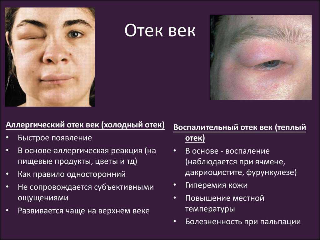 Как убрать мешки под глазами: что помогает, как избавиться, причины появления, виды лечение и процедур
