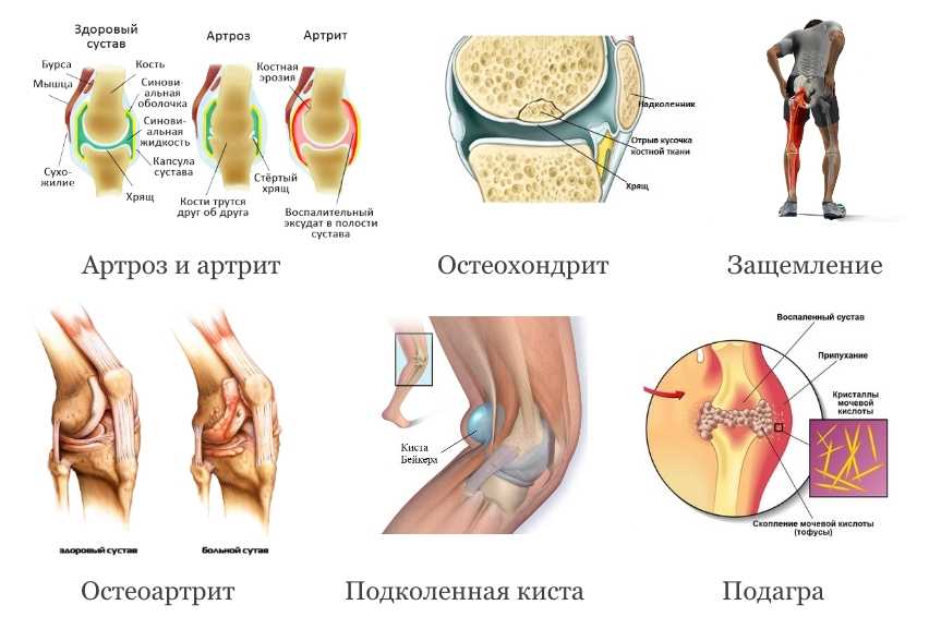 Артроз кисти и пальцев рук. причины, симптомы, диагностика и лечение артроза