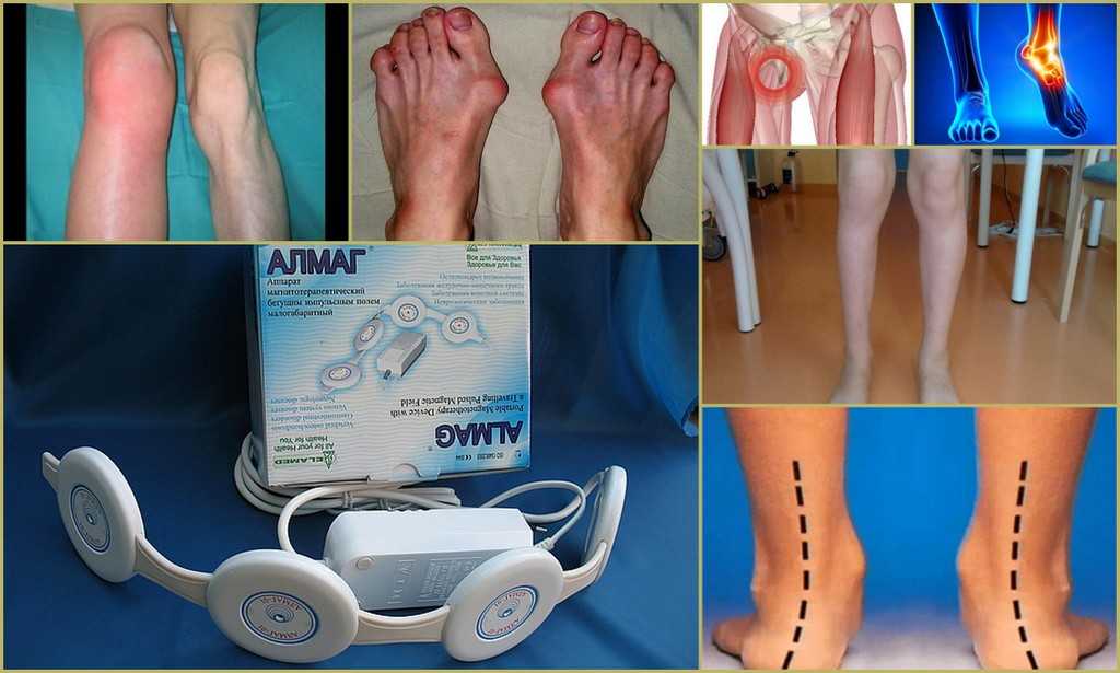 Алмаг ноги. Алмаг 01 на голеностопный сустав. Магнитная терапия алмаг. Алмаг-01 голеностоп. Аппарат для коленного сустава алмаг.