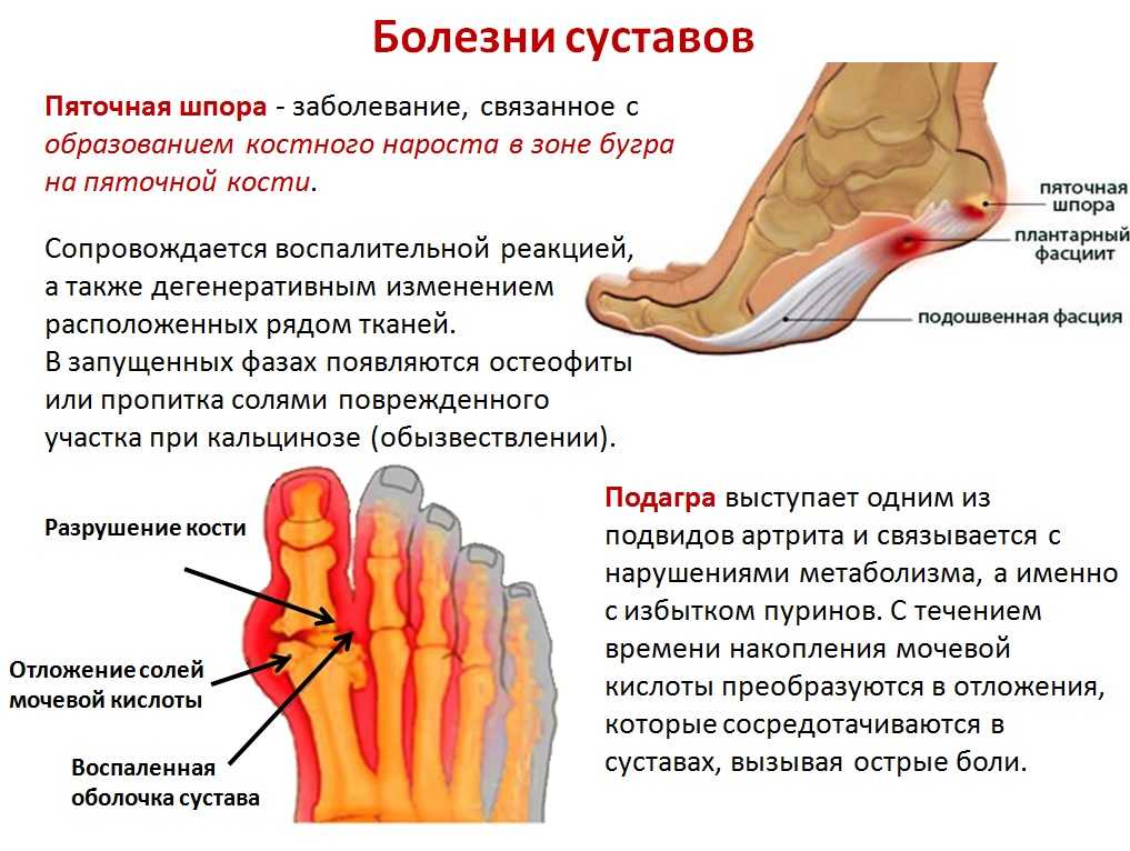 Колики в пятках