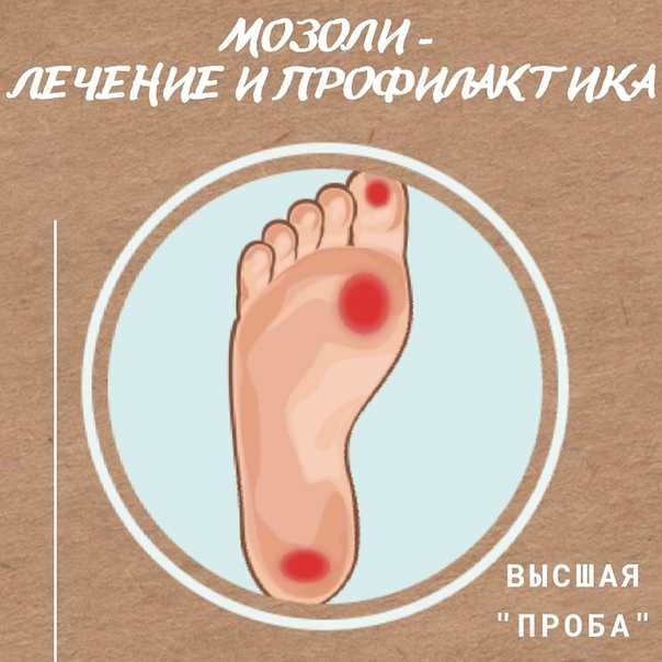 Лечение мозоли на стопе