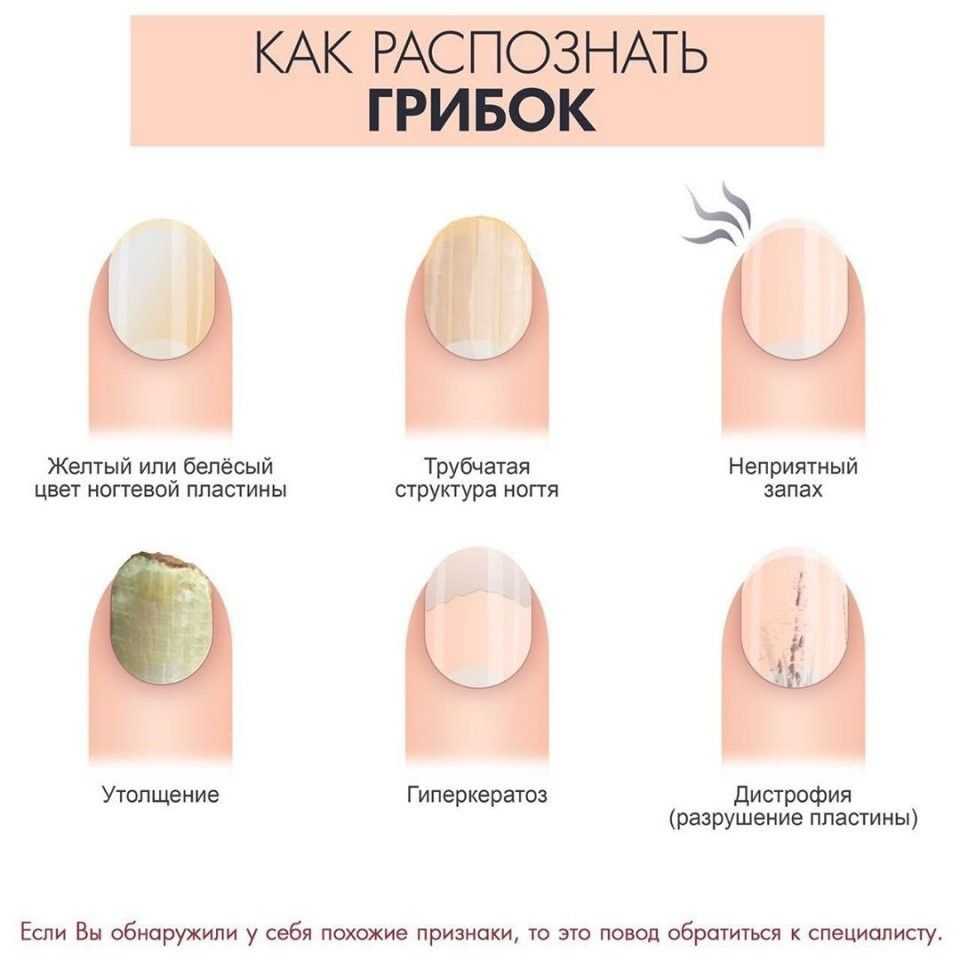 Пропилы на ногтях после аппаратного маникюра. анонимно. привет!  делала аппаратный маникюр себе и возле кутикулы перепилила ноготь. | маникюр