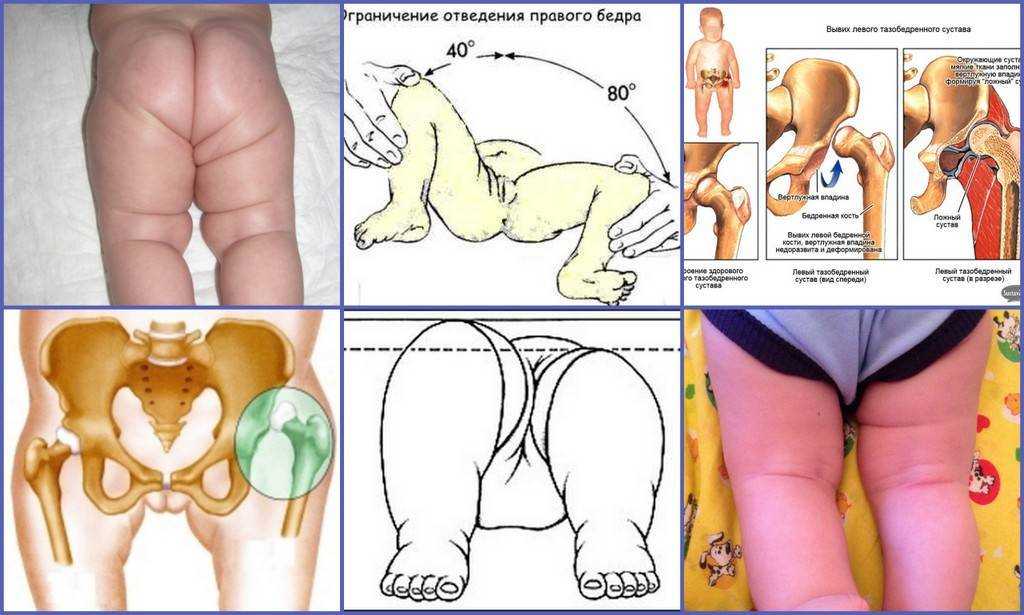 Что такое дисплазия тазобедренных суставов у детей: как проявляется, методы лечения патологии