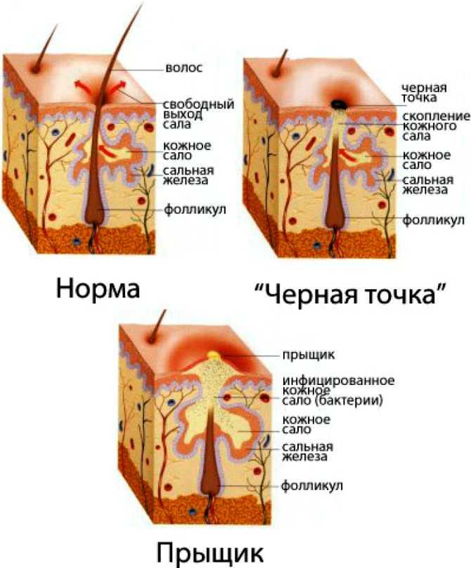Черные точки ( комедоны ) на коже лица и тела. как избавиться от черных точек в домашних условиях? :: polismed.com