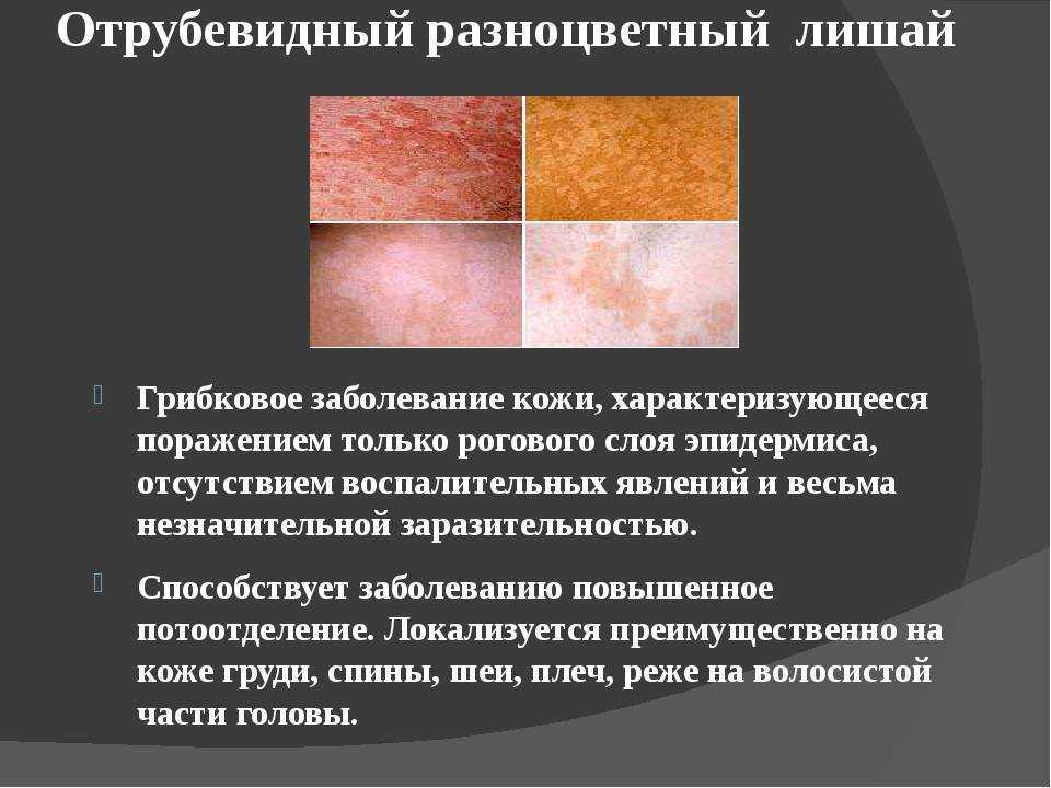 Вагинальный кандидоз, грибковая инфекциея слизистой влагалища