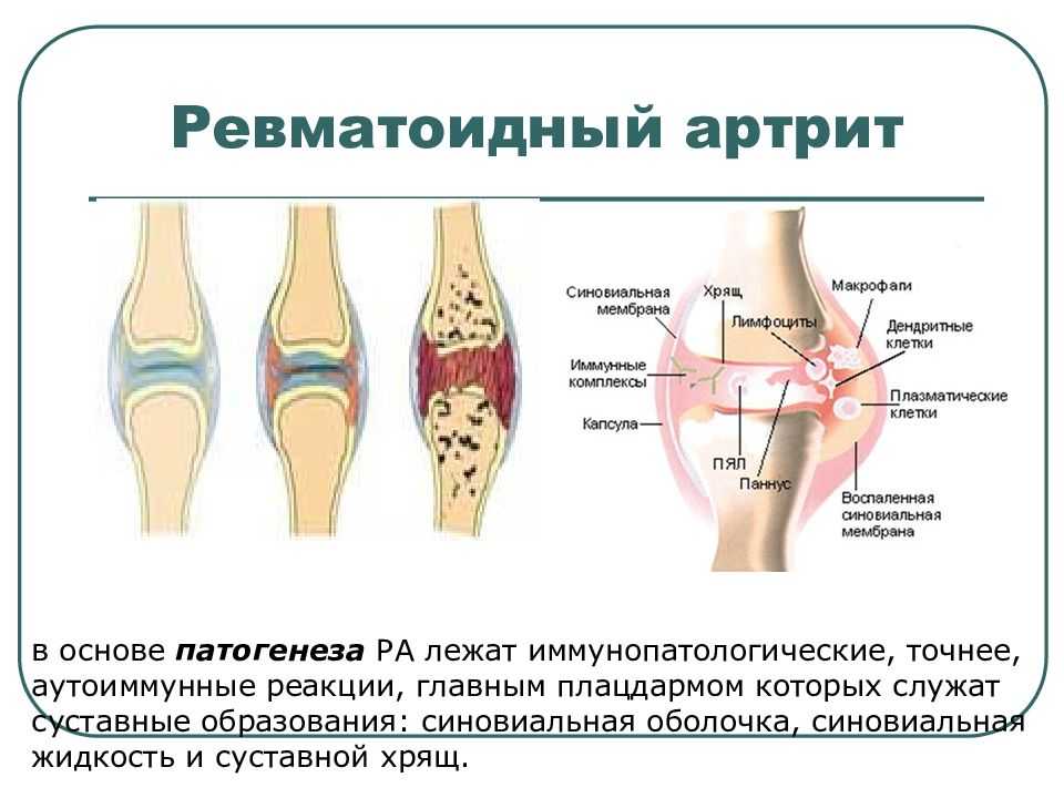 Ревматическое поражение суставов. Суставные поражения при ревматоидном артрите. Ревматоидный артрит синовиальная жидкость. Ревматоидный артрит аутоиммунное заболевание патогенез. Ревматоидный артрит коленного сустава клиника.