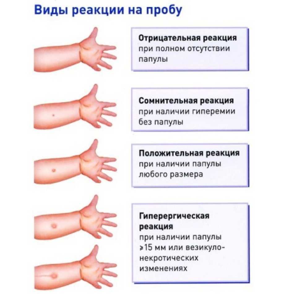 На какой день проверяют манту у ребенка