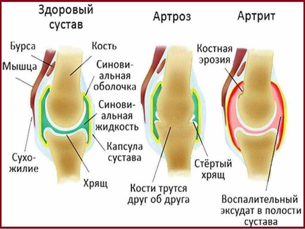 Артроз коленей форум. Ревмоартроз суставов. Классификация артрозов. Артроз суставов верхних конечностей. Витамины от артроза суставов.