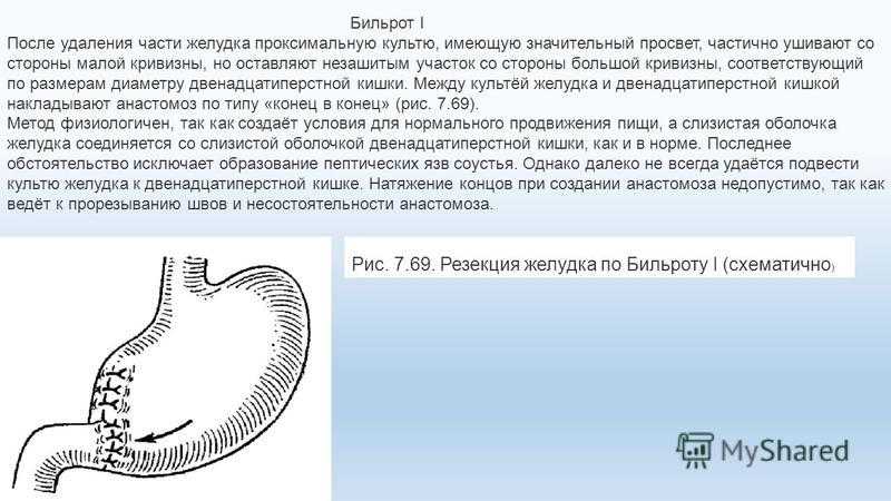 После удаления желудка. Дита после резекциижелудка. Питание после резекции желудка. Диета после гастрэктомии желудка. Диета после резекции желудка для похудения.