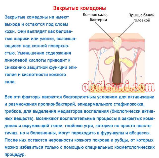 Комедоны