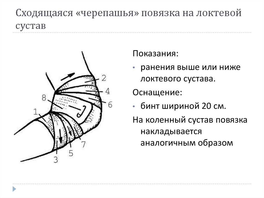 Черепашья повязка на коленный и локтевой суставы: сходящаяся и расходящаяся - твой суставчик