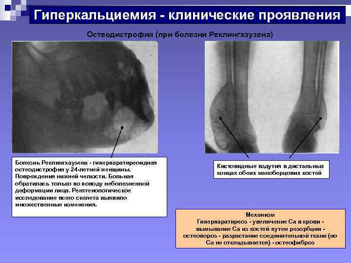 Гиперкальциемия. Гиперкальциемия патогенез симптомов. Клинические симптомы гиперкальциемии:. Механизм развития гиперкальциемии. Гиперкальциемия проявления.