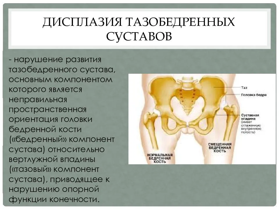 Дисплазия мыщелков бедренной кости, подвывих и наклон надколенника | лечение и диагностика
