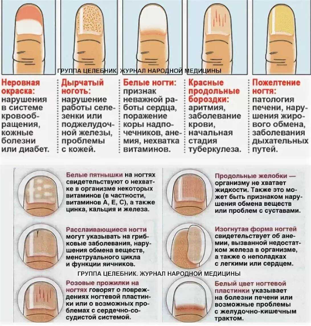 Вросший ноготь: популярно об онихокриптозе | медицинский центр да!