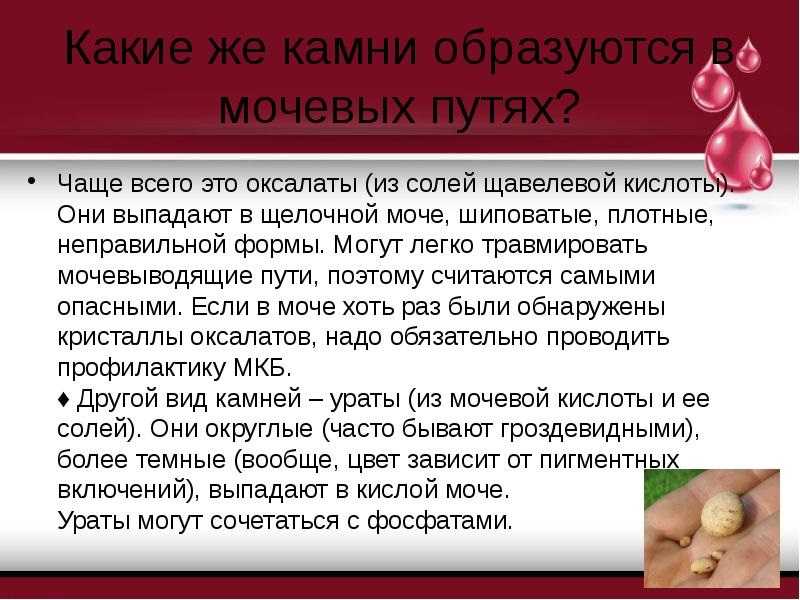 Ведделлит камень в почках