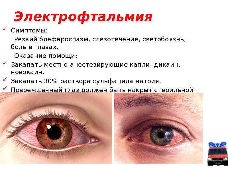 Мешки под глазами