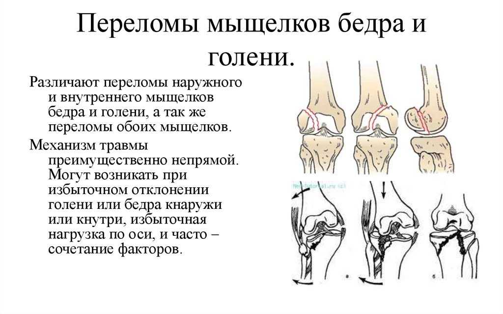 Открытый перелом бедренной кости карта вызова