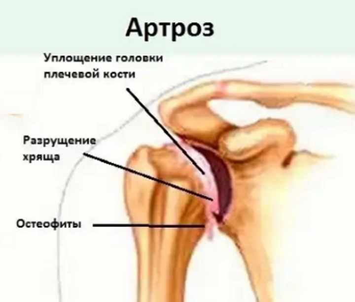 Артроз: лечение, симптомы, причины