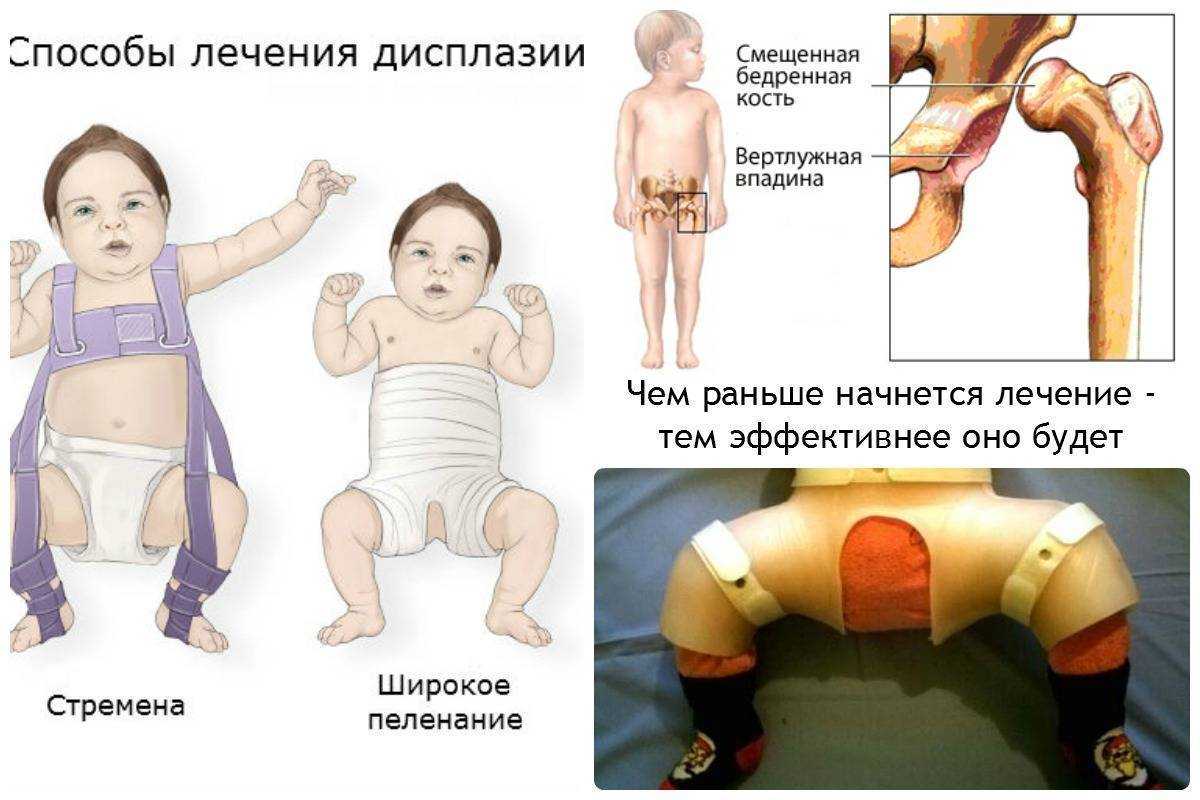 Дисплазия тазобедренных суставов у детей, лечение и симптомы