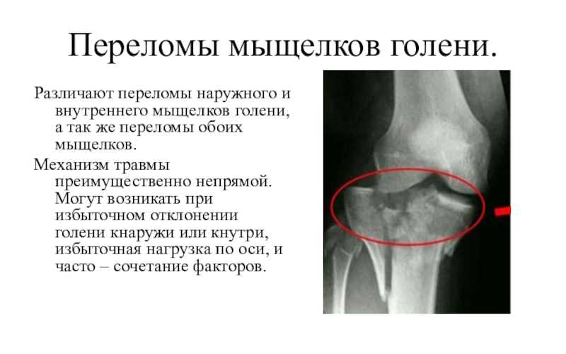 Мыщелок большеберцовой кости лечение