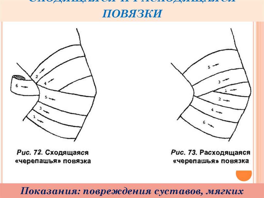 Черепашья расходящаяся повязка на коленный сустав. Черепашья повязка сходящаяся и расходящаяся. Черепашья сходящаяся на локтевой сустав. Черепашья» повязка сходящаяся (Черепичная).