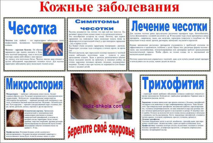 Стригущий лишай у человека